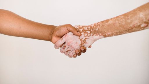Comment gérer le vitiligo de mon enfant ?